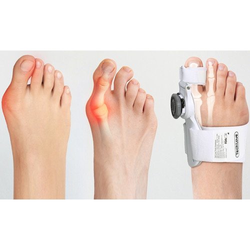 Dlaha na nohu Hallux Valgus 2 ks nastaviteľná Bandáž na hallux valgus