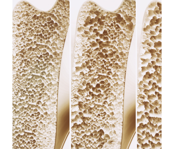 Čo je osteoporóza: príznaky, rizikové faktory a metódy prevencie