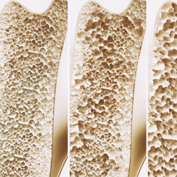 Čo je osteoporóza: príznaky, rizikové faktory a metódy prevencie