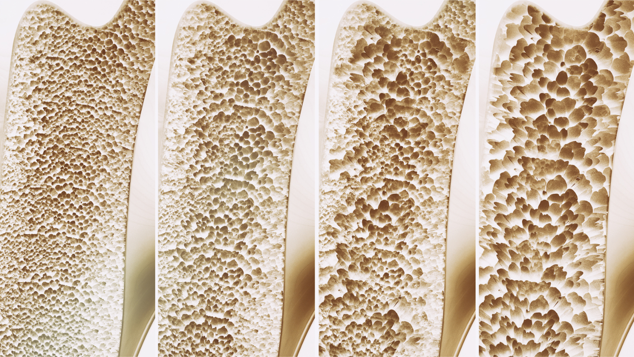 Čo je osteoporóza: príznaky, rizikové faktory a metódy prevencie  - Ortek